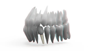 cuanto-cuesta-implante-dental