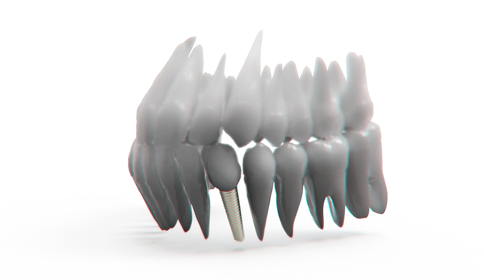 cuanto-cuesta-implante-dental