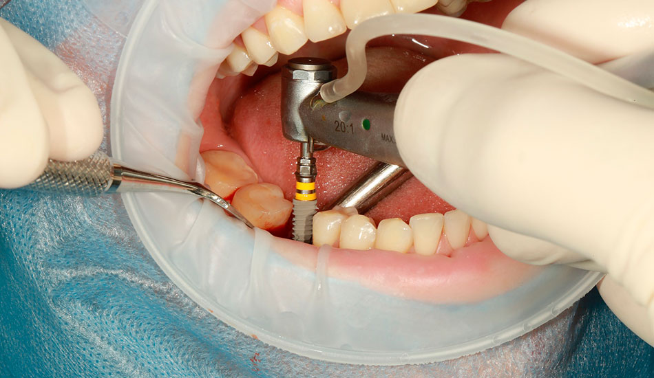 cuanto-cuesta-un-implante-dental