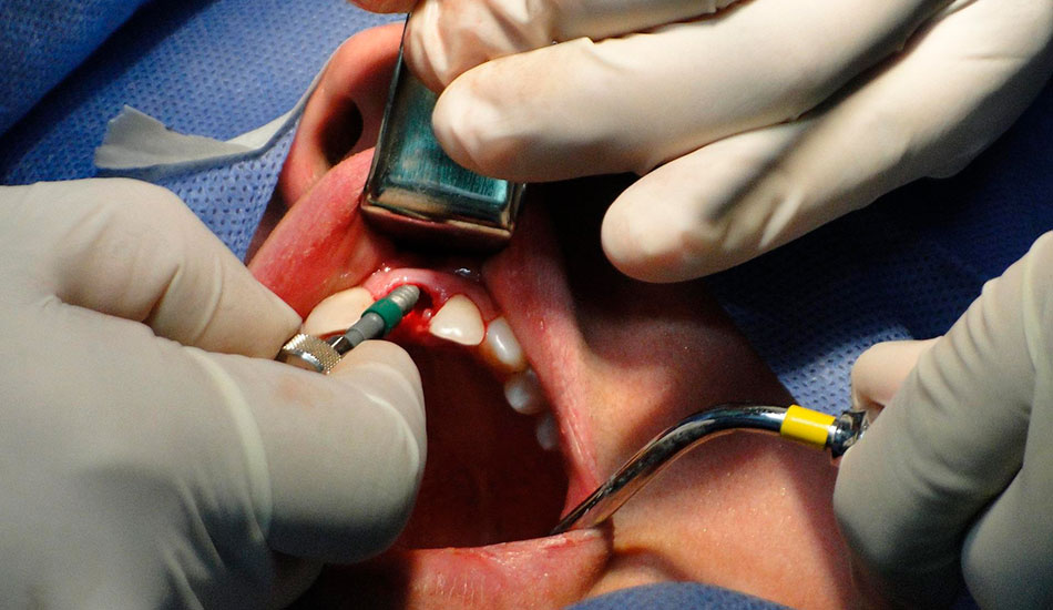 precio-implante-dental-con-seguro
